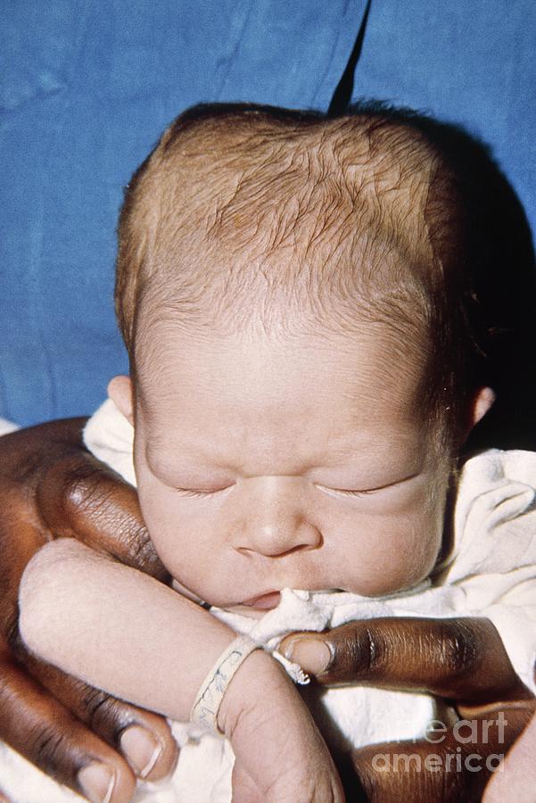 Child Suffering From Bilateral Cephalohaematoma Photograph by St Mary's ...