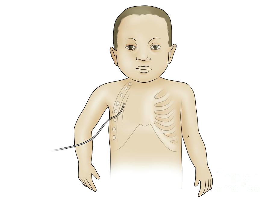 Child With Chest Drain Photograph by Maurizio De Angelis/science Photo Library