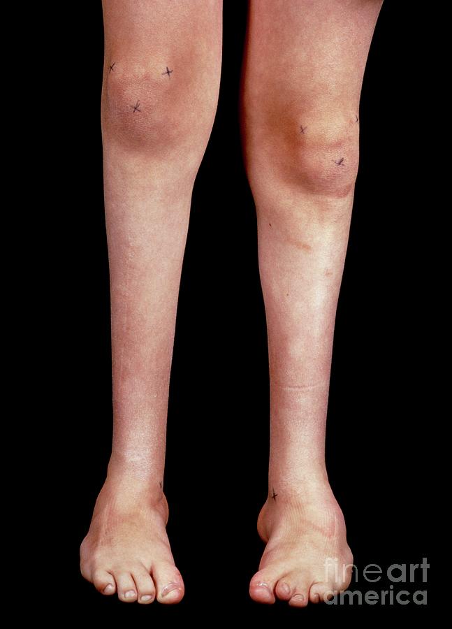 Child With Club Feet (talipes) Photograph by Biophoto Associates/science Photo Library