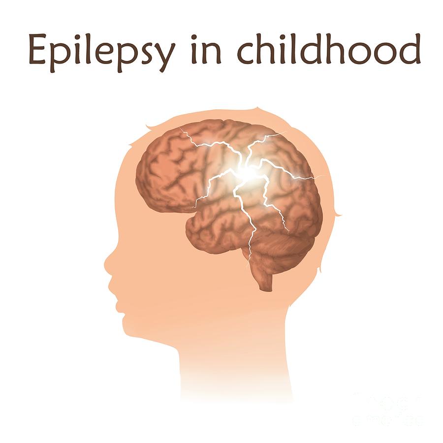 Childhood Epilepsy Photograph by Veronika Zakharova/science Photo Library