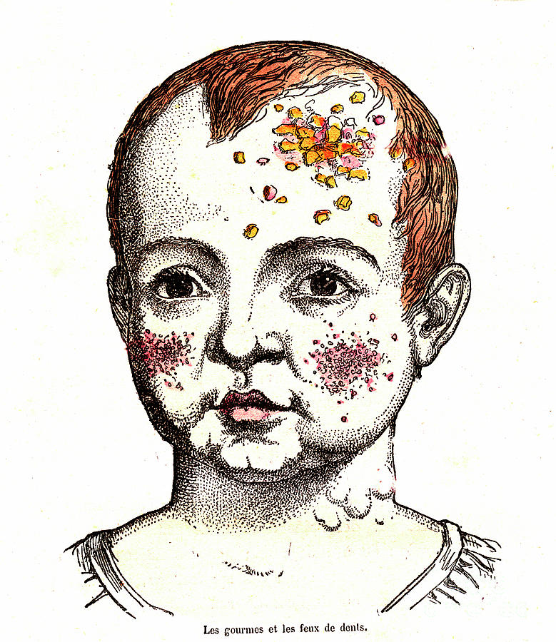 Childhood Impetigo And Toothache Photograph by Collection Abecasis/science Photo Library