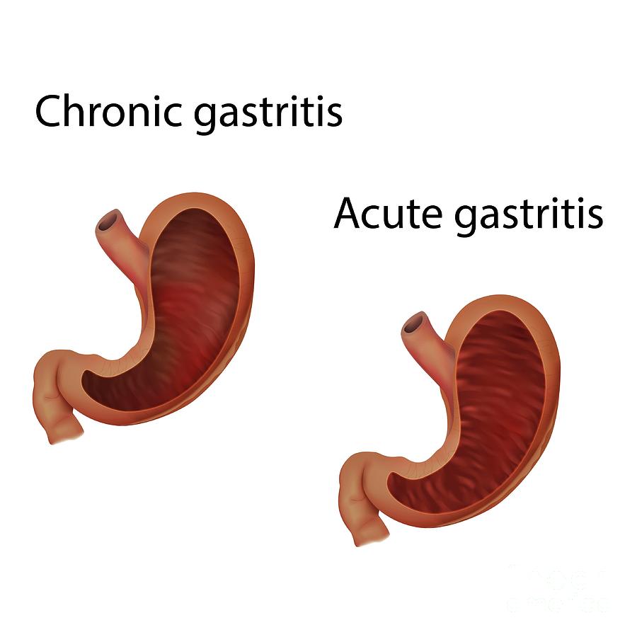 Gastrite Cronica