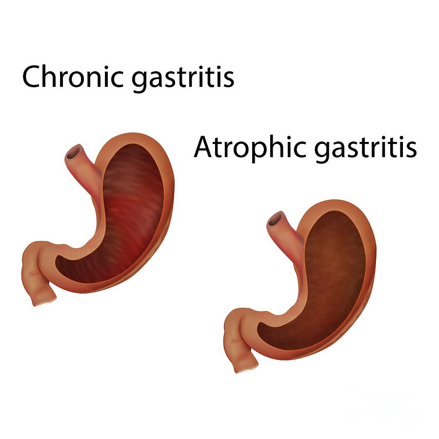 Chronic And Atrophic Gastritis Photograph by Veronika Zakharova/science ...