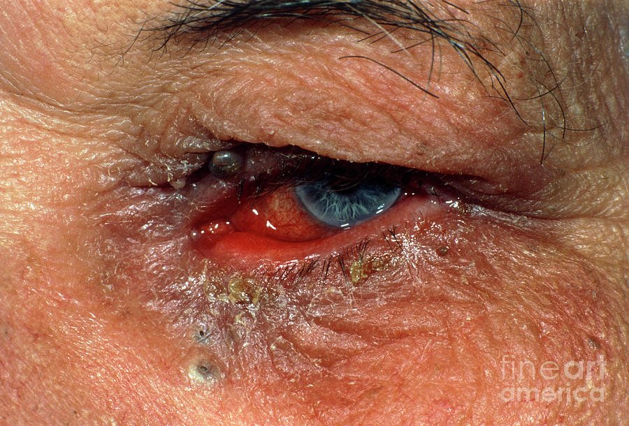 Chronic Conjunctivitis Caused By Ectropion Photograph By Dr Chris Halescience Photo Library 