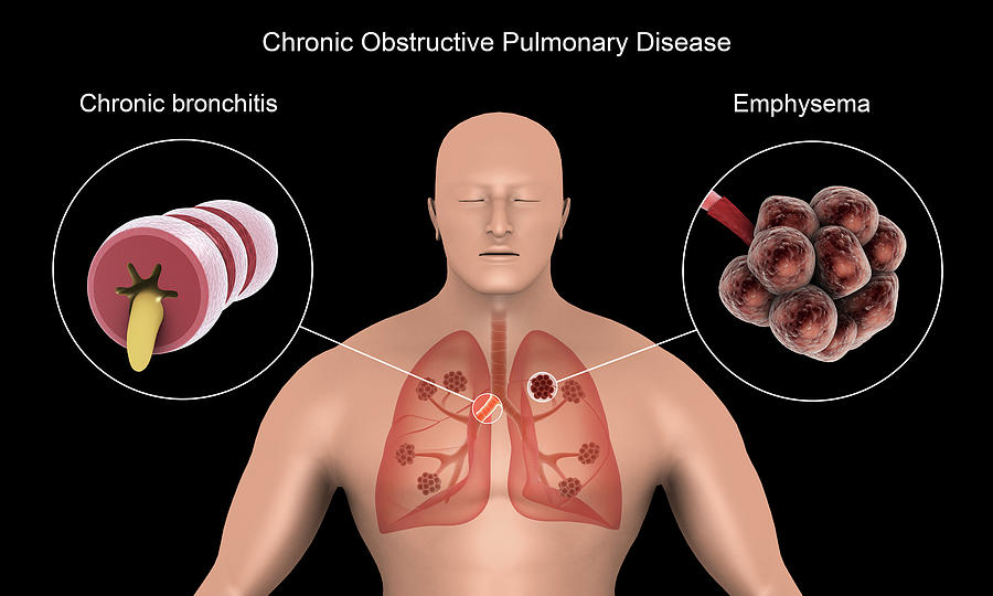 lung-with-chronic-obstructive-pulmonary-disease-stock-vector-image