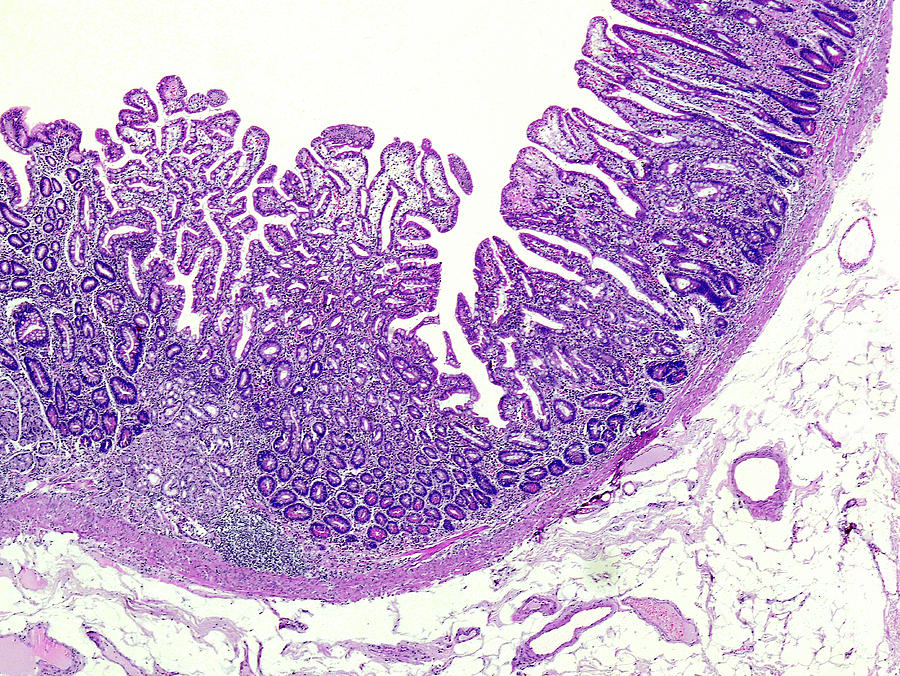 Chronic Superficial Gastritis Photograph by Nigel Downer/science Photo ...