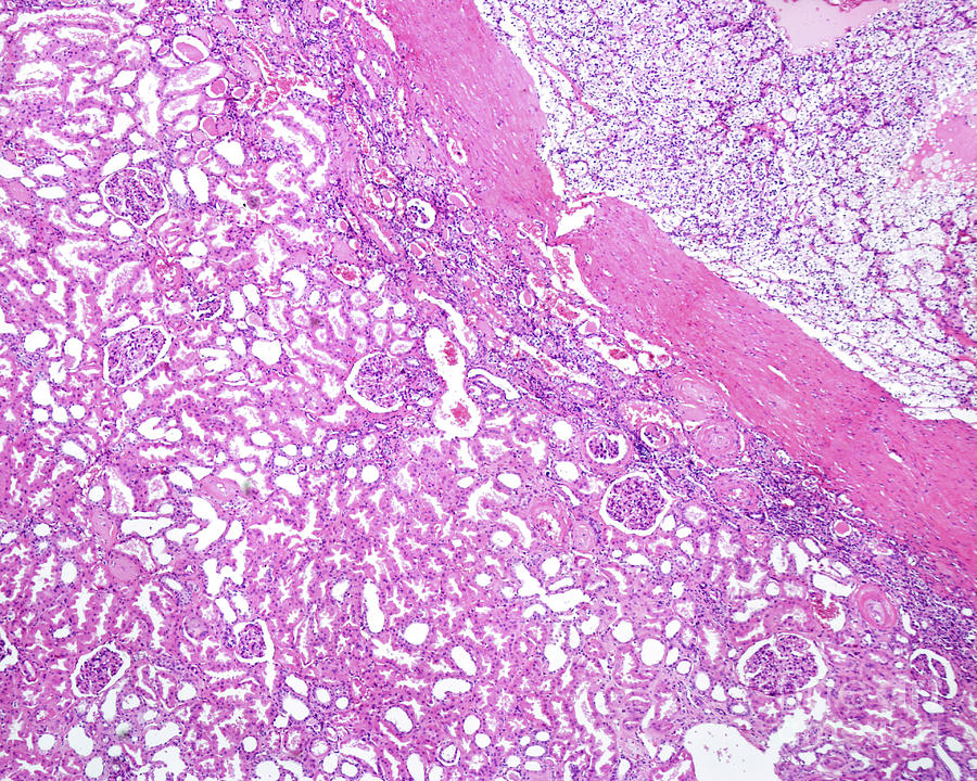 Clear Cell Renal Carcinoma Photograph By Jose Calvo   Science Photo 