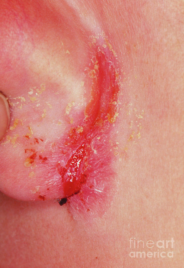 Close Up Of Eczema On Ear Lobe Photograph By Dr Hcrobinsonscience Photo Library 7710