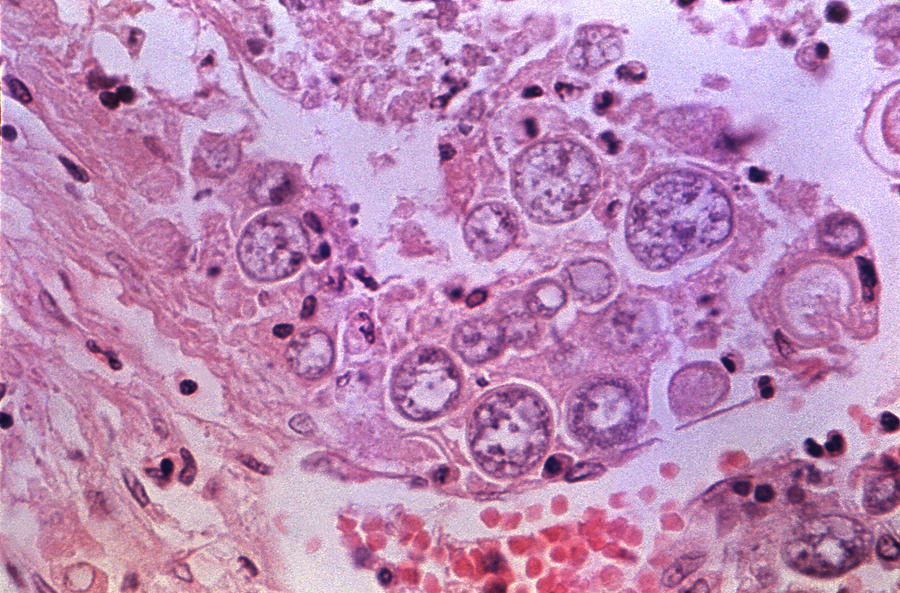 Coccidioidomycosis Valley Fever Lm Photograph By Science Source Pixels 