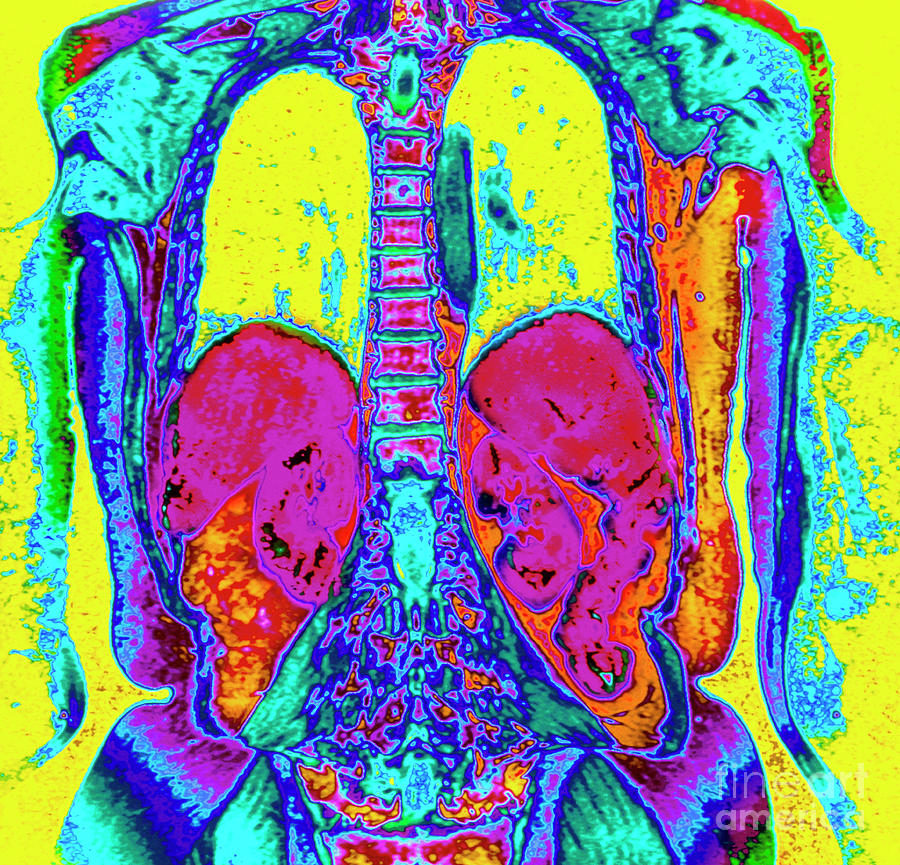 Col Mri Scan Of Thorax Abdomen Of Elderly Woman Photograph By Simon Fraser Royal Victoria