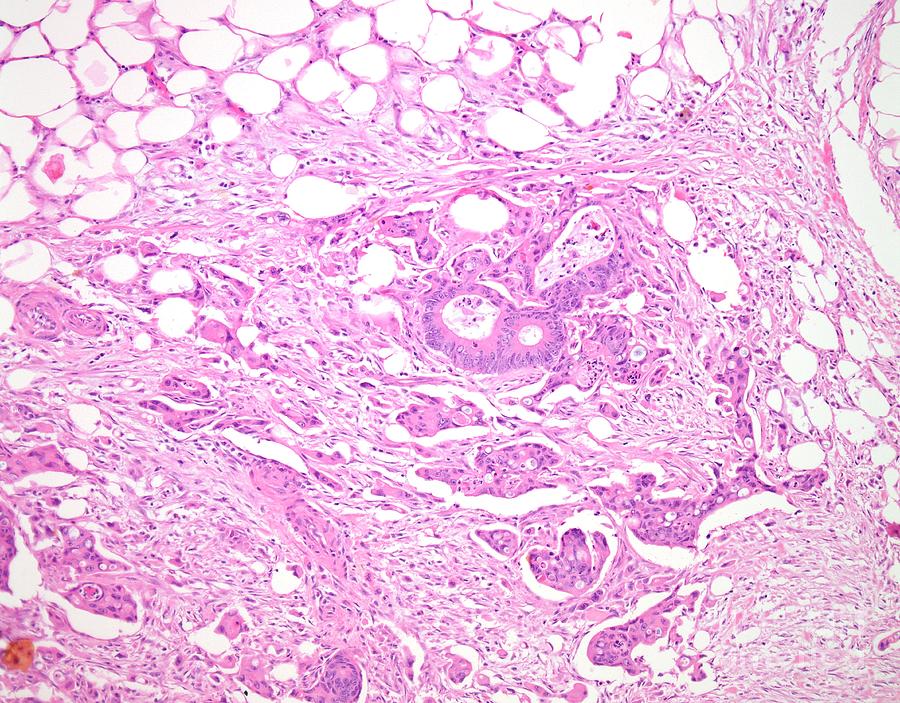 Colon Cancer And Fat Tissue Photograph By Webpathologyscience Photo Library 7420