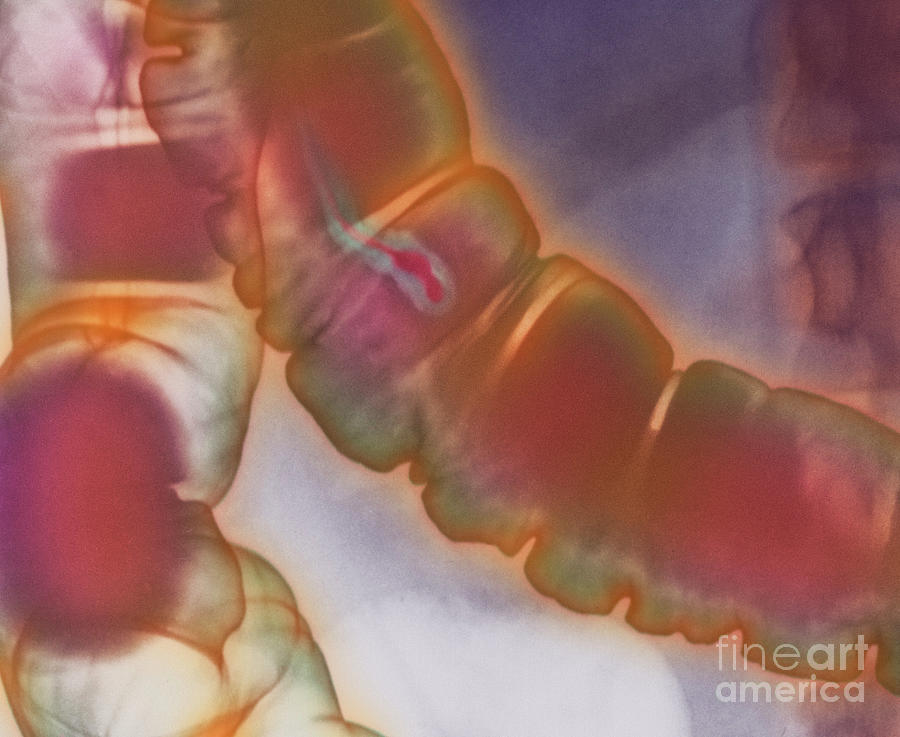 Colonic Polyp X Ray Photograph By Cnri Science Photo Library