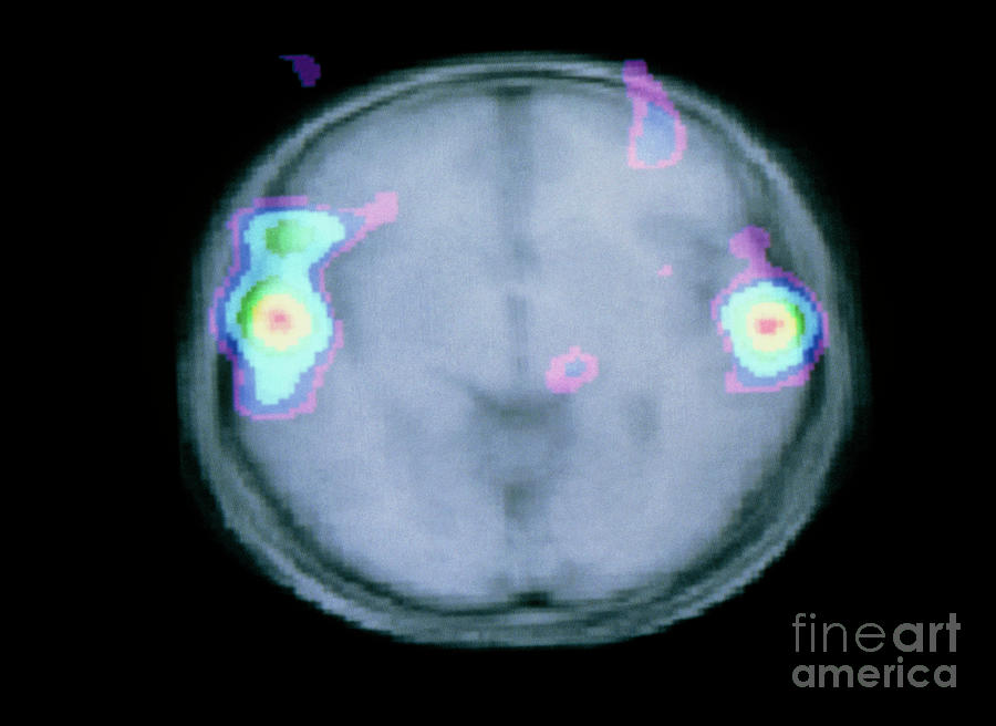 Colour Pet Brain Scan During Auditory Activity Photograph by Montreal Neurological Institute/science Photo Library