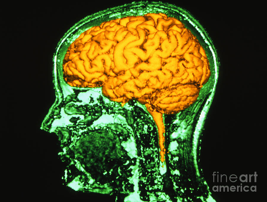 Coloured 3-d Mri Brain Scan In Head Cross-section Photograph by Montreal Neurological Institute/science Photo Library