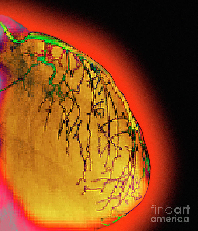 Coloured Angiogram Of Coronary Arteries Of Heart Photograph by Science Photo Library