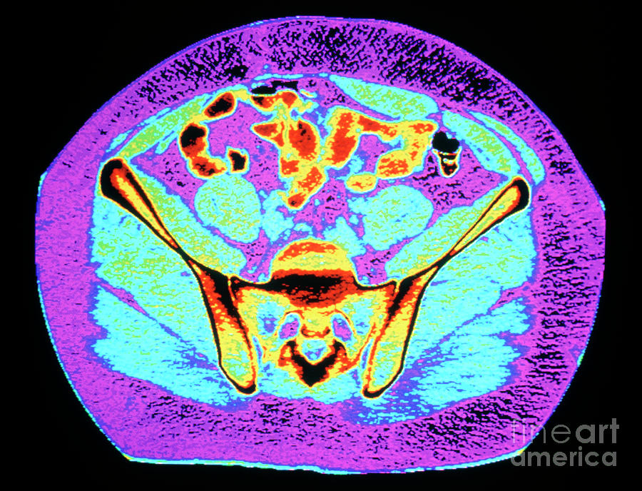 Skeleton Photograph - Coloured Ct Scan Of A Normal Adult Pelvis by John Greim/science Photo Library