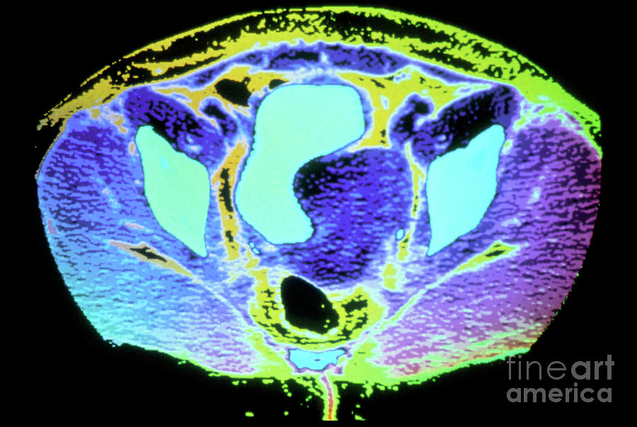 Coloured Ct Scan Of Large Fibroid Tumour In Uterus Photograph by Gjlp ...