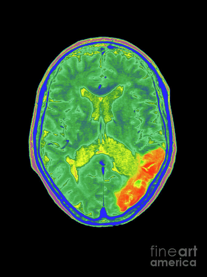 Coloured Mri Brain Scan Showing A Stroke By Simon Fraser Royal Victoria Infirmary Newcastle