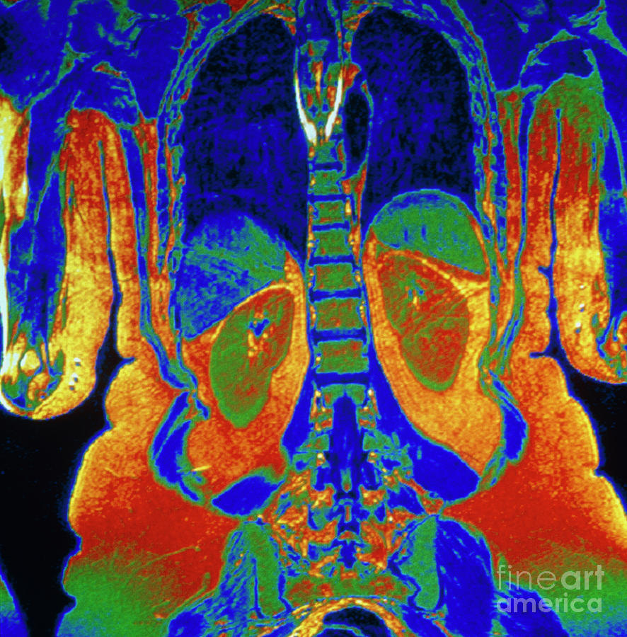 Coloured Mri Scan Of Human Thorax & Abdomen Photograph by Centre Jean ...