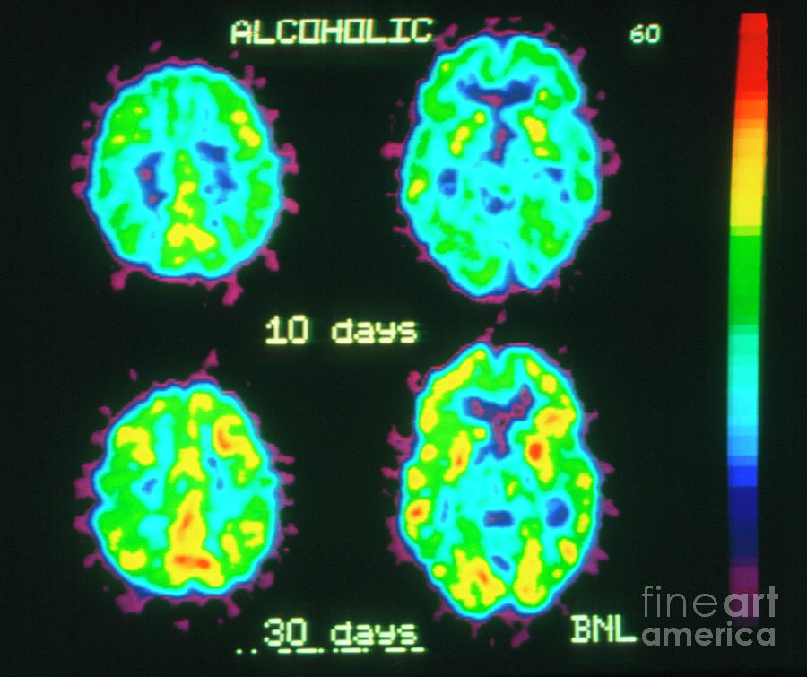 Coloured Pet Brain Scans Of Alcohol Withdrawal Photograph by Pascal Goetgheluck/science Photo Library