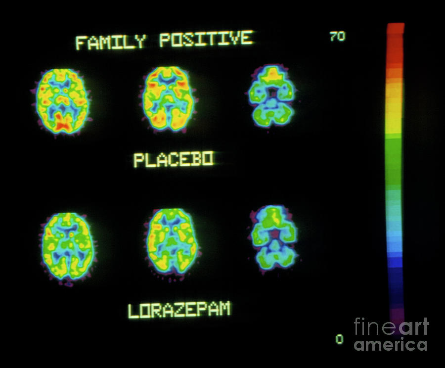 Coloured Pet Brain Scans Showing Lorazepam Action Photograph by Pascal Goetgheluck/science Photo Library