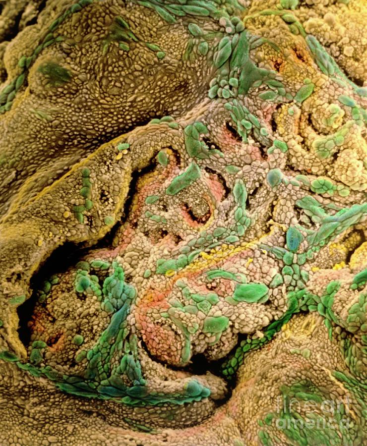 Coloured Sem Of Adenocarcinoma Of The Human Uterus Photograph by Professors P.m. Motta & S. Makabe/science Photo Library