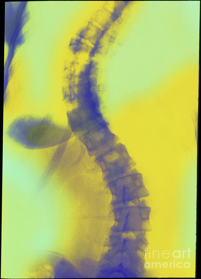 Coloured X-ray Of Scoliosis (curvature) Of Spine Photograph by Princess Margaret Rose Hospital/science Photo Library