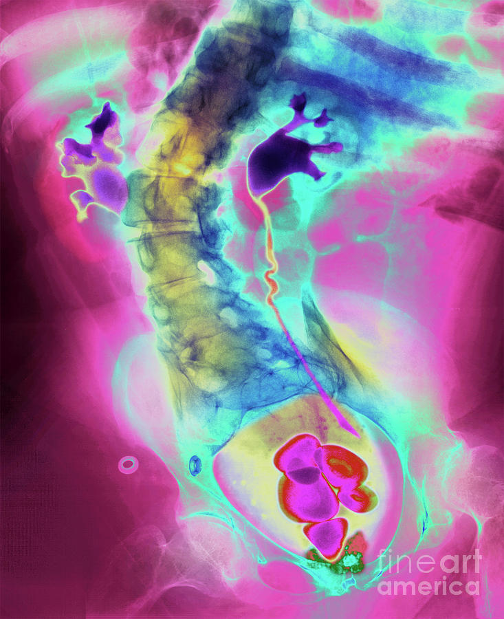 Coloured X-ray Showing Bladder Stones Photograph by Science Photo ...