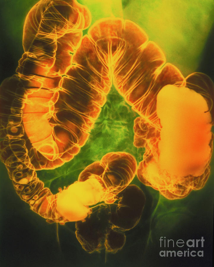 Coloured X-ray Showing Diverticulitis Of The Colon Photograph by Science Photo Library