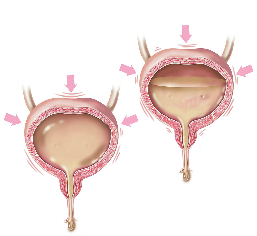 Comparison Of A Full Bladder And An Photograph by Elise Walmsley Mac ...