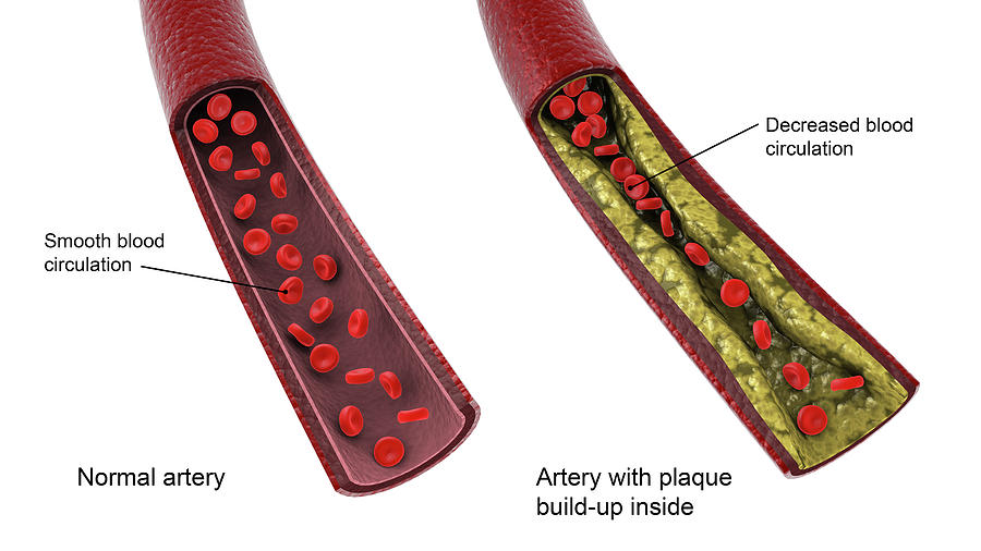 Comparison Of A Healthy Artery And An Photograph by Stocktrek Images