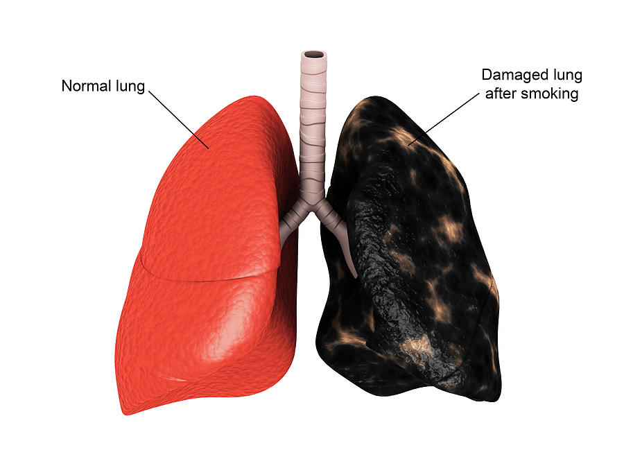 Comparison Of A Healthy Lung Vs Photograph by Stocktrek Images