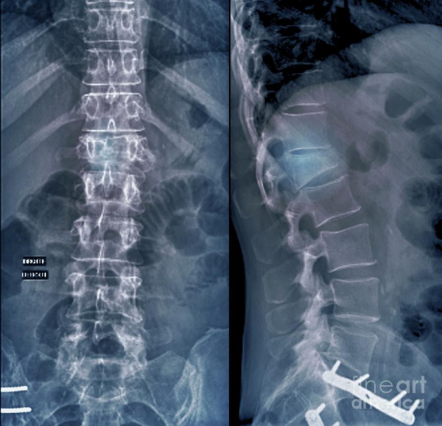 Compression Fracture Of A Lumbar Vertebra by Science Photo Library