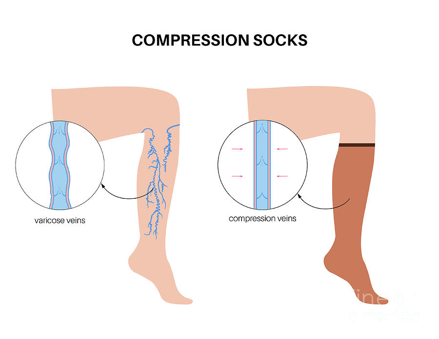 Compression Socks For Varicose Veins by Pikovit / Science Photo Library