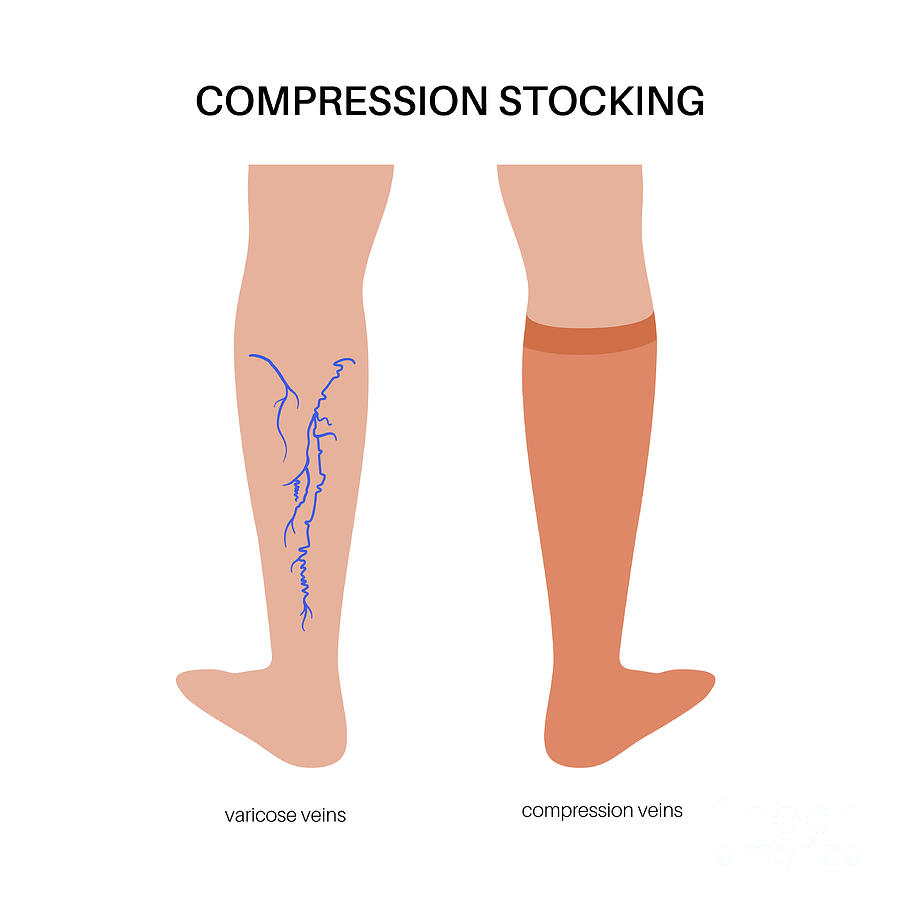 Compression Stockings For Varicose Veins Photograph by Pikovit