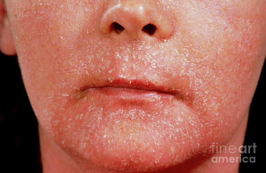 Contact Dermatitis Photograph by St Bartholomew's Hospital/science ...