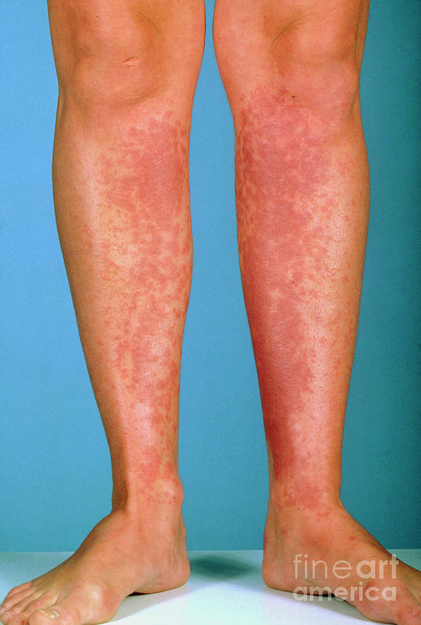 Skin Rash On Shins
