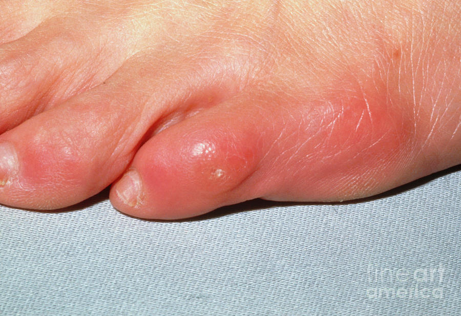 Corn (callus) On The Little Toe In An Adult Photograph by Jane Shemilt/science Photo Library