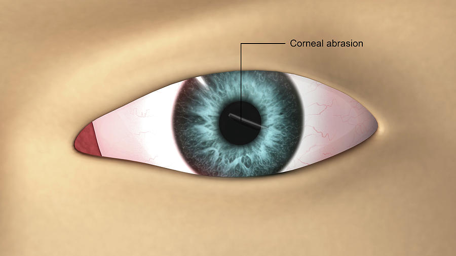 Corneal Abrasion In The Human Eye Photograph by Stocktrek Images - Pixels