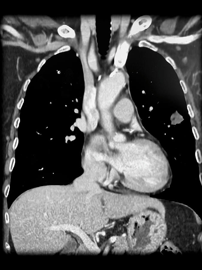 Coronal Ct Reconstruction With Lung Mass Photograph by Living Art ...