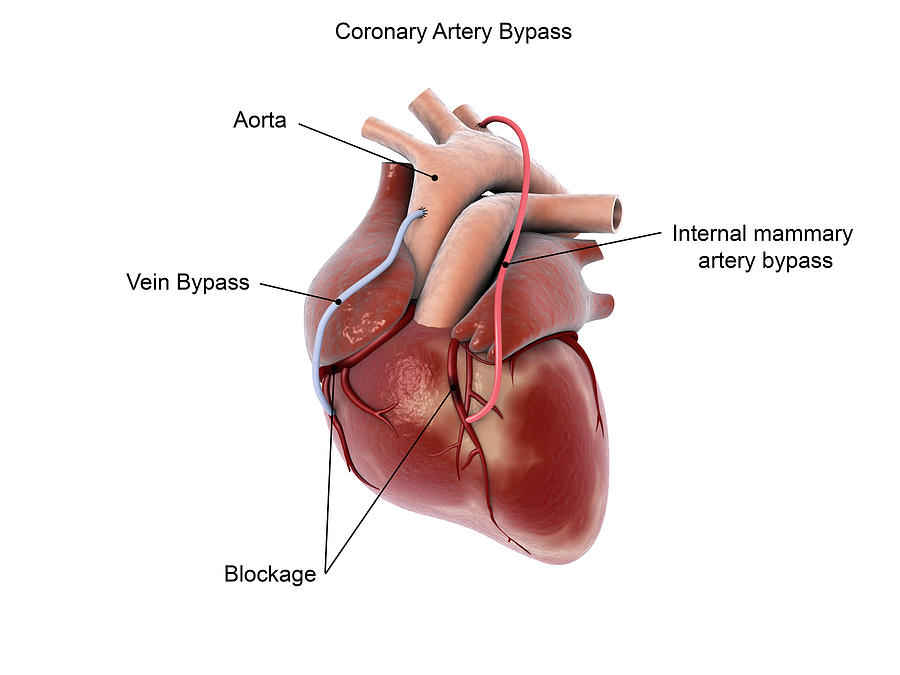 Coronary Artery Bypass Of The Human Photograph by Stocktrek Images