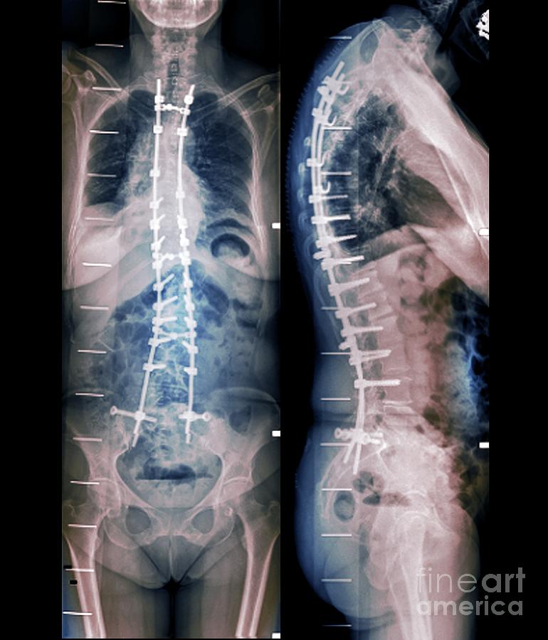 Corrected Spine In Osteoarthritis Photograph by Zephyr/science Photo Library