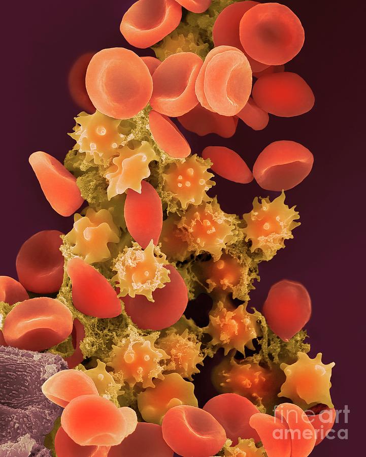 Crenate Red Blood Cells Photograph by Dennis Kunkel Microscopy/science ...