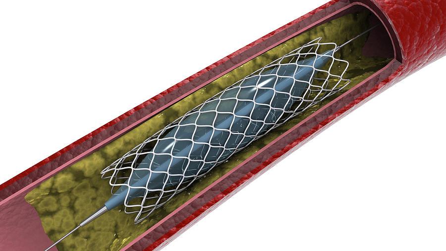 Cross-section Of Artery Showing Photograph by Stocktrek Images