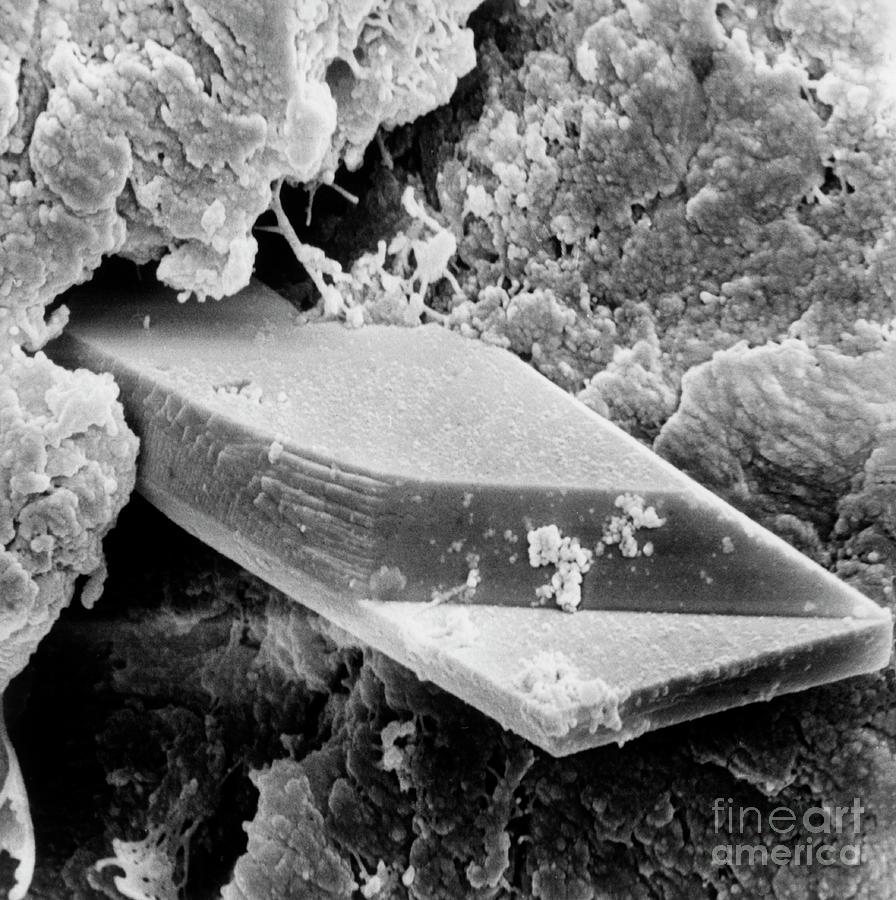 Crystal Of Calcium Phosphate In Knee Joint Photograph by Dr Gilbert Faure/science Photo Library