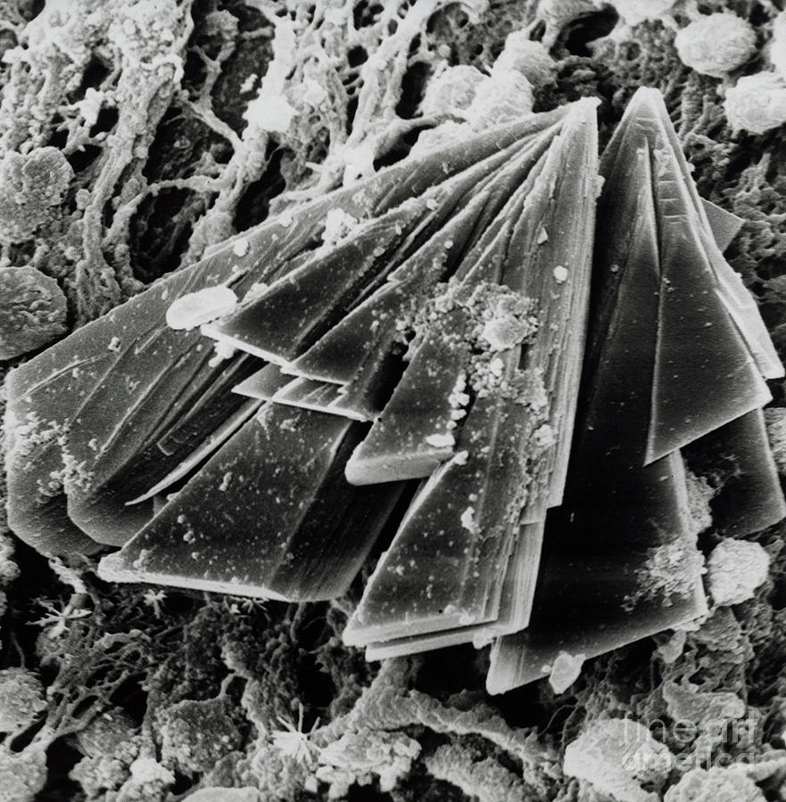 Crystals Of Calcium Phosphate In Knee Joint Photograph by Dr Gilbert Faure/science Photo Library
