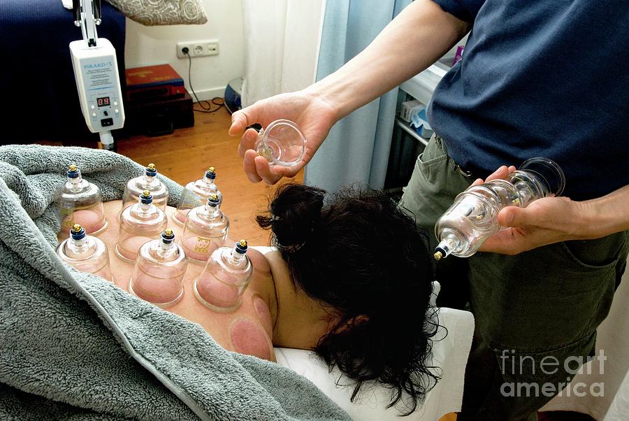 Cupping Acupuncture Photograph by Henny Allis/science Photo Library