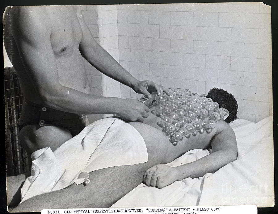 Cupping Patient During 1920s Revival Photograph by Bettmann Cupping Patient During 1920s Revival Photograph by Bettmann