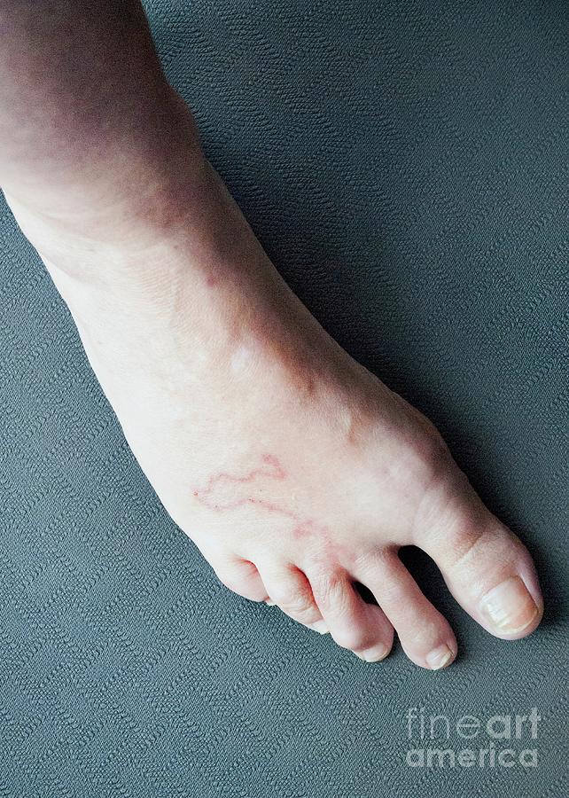 Bare Feet Health Risks: Larva Migrans, MRSA, Fungal Infection, Tungiasis​