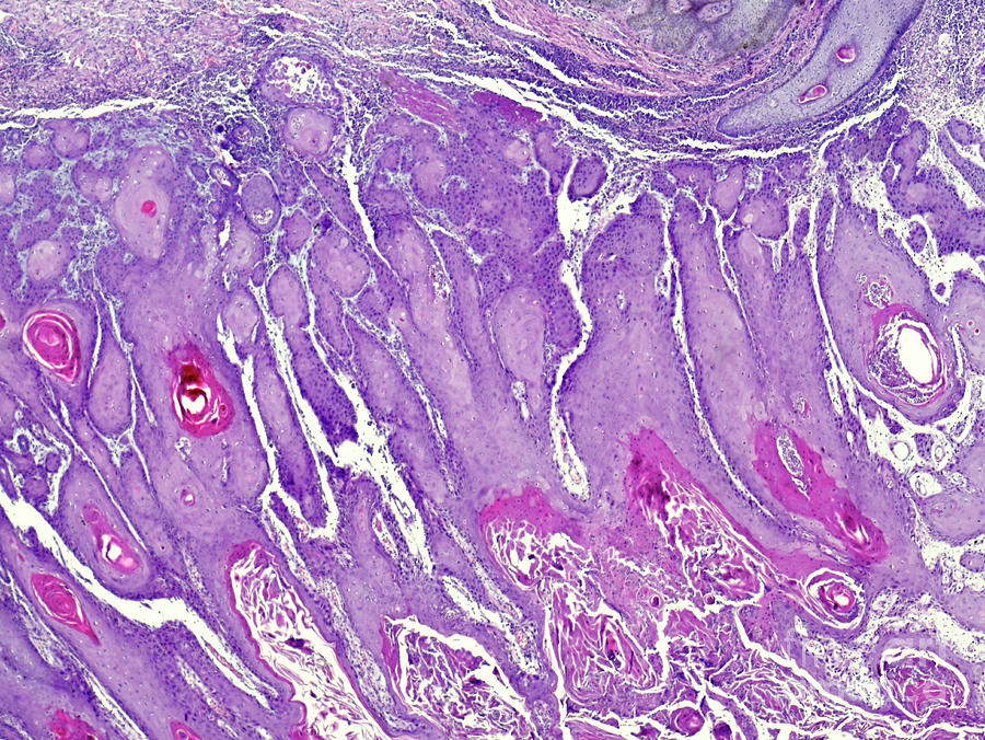 Cutaneous Squamous Cell Carcinoma Photograph by Nigel Downer/science Photo Library